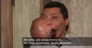 “Cierpi na dysplazję od dziecka”. 23-letni Meksykanin podda się zabiegowi usunięcia prawie 5-kilogramowego guza na twarzy