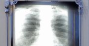 Zdjęcie rentgenowskie pozwala przewidzieć zgon