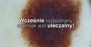 Czerniak. Jak się przed nim chronić?