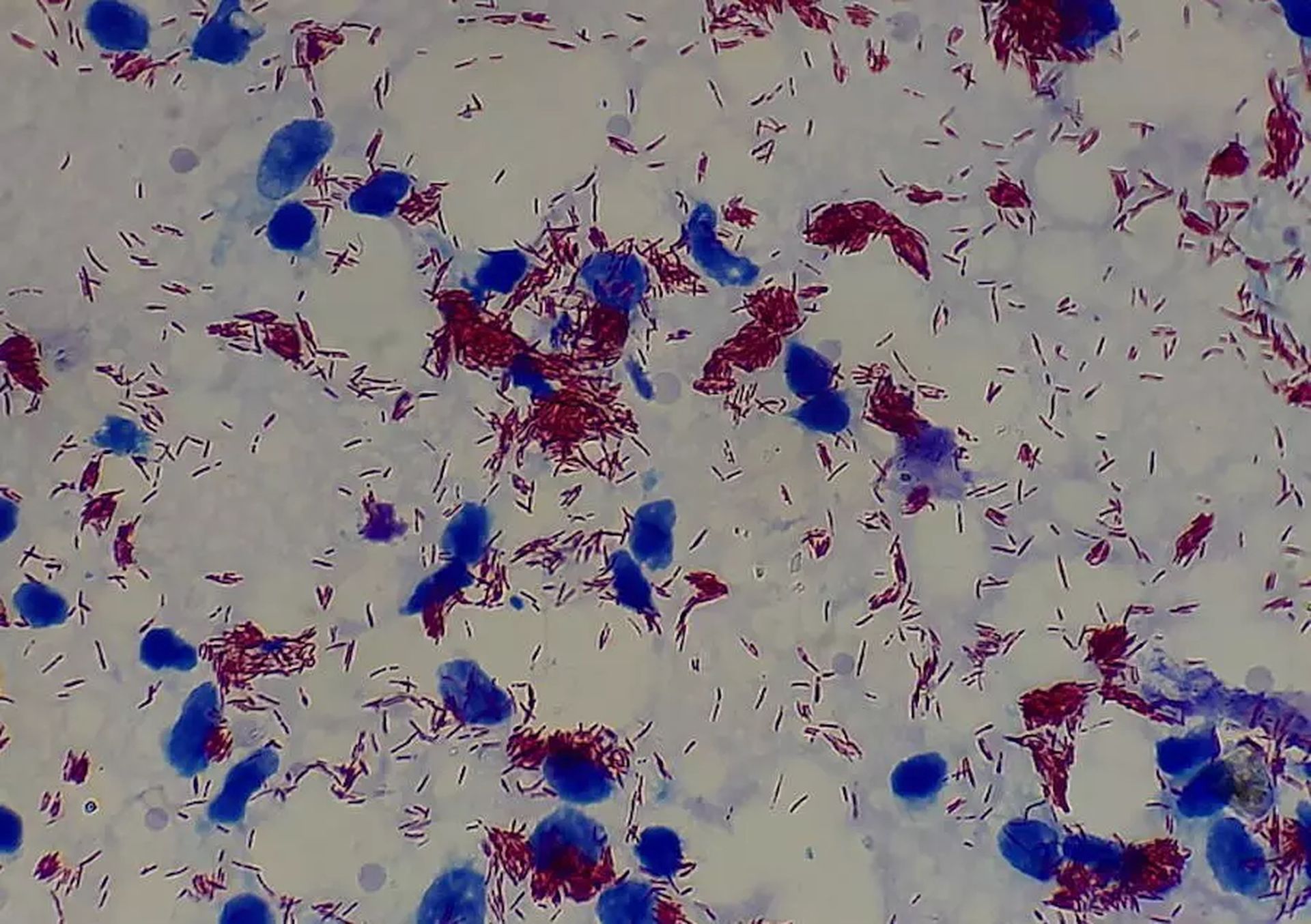 Trąd w Ameryce. Był obecny na długo przed przybyciem Europejczyków