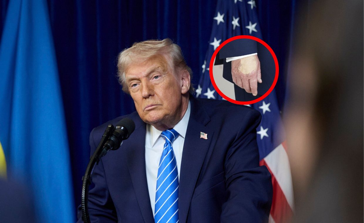 Siniaki na dłoni. Wracają pytania o zdrowie Trumpa