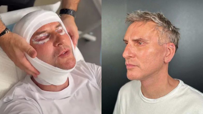 TYLKO NA PUDELKU: Krzysztof Gojdź ZDJĄŁ SZWY i pokazał, jak wygląda jego poliftingowa twarz warta 150 tysięcy złotych