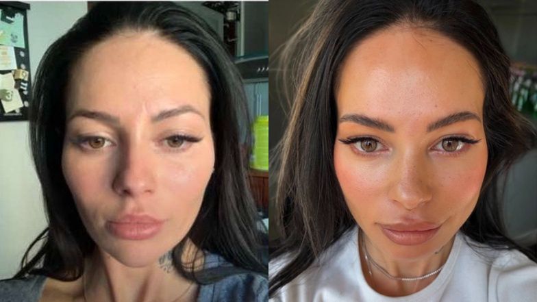 Sylwia Szostak pokazała, jak botoks zmienił jej twarz. "Żwacze zostały prawie całkowicie wyłączone z pracy"