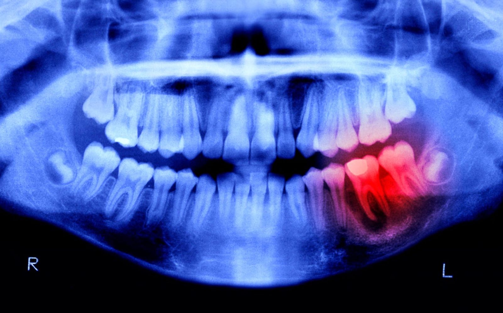 Nowe zęby zamiast implantów? Japoński lek wchodzi do badań