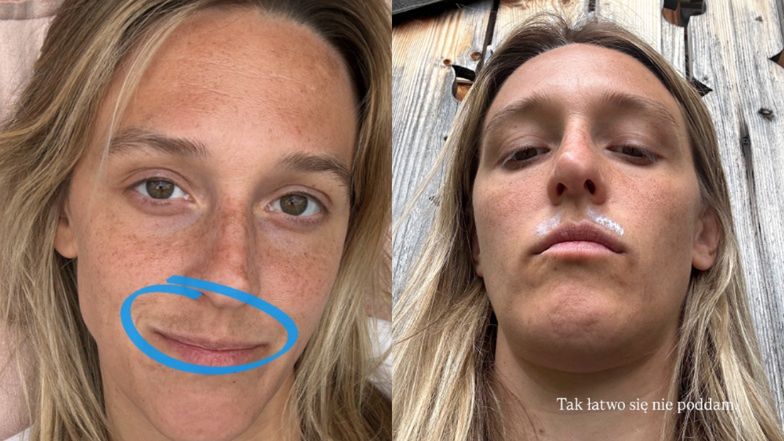 Aleksandra Żebrowska walczy ze zmianami na twarzy: "To przebarwienia po ciąży, pogarszają się od słońca i wyglądają JAK WĄSY"