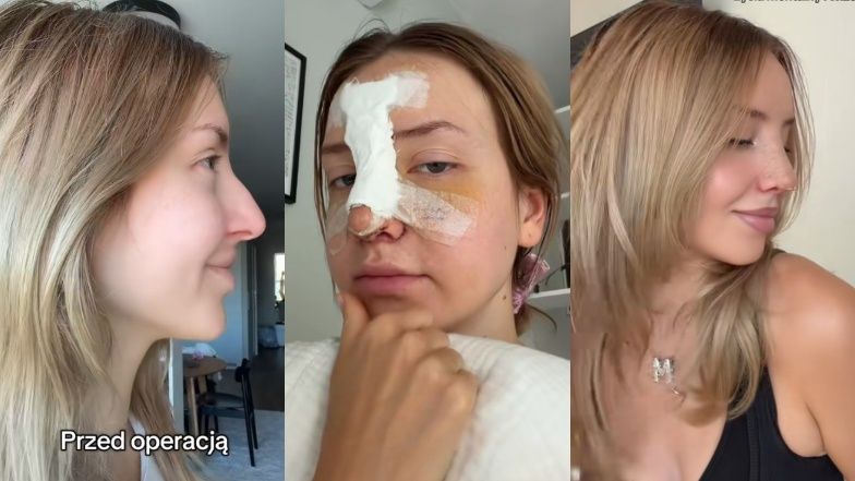Monika Kociołek zafundowała sobie NOWY NOS. Pokazała efekty PRZED I PO. Zmiana na plus? (ZDJĘCIA)