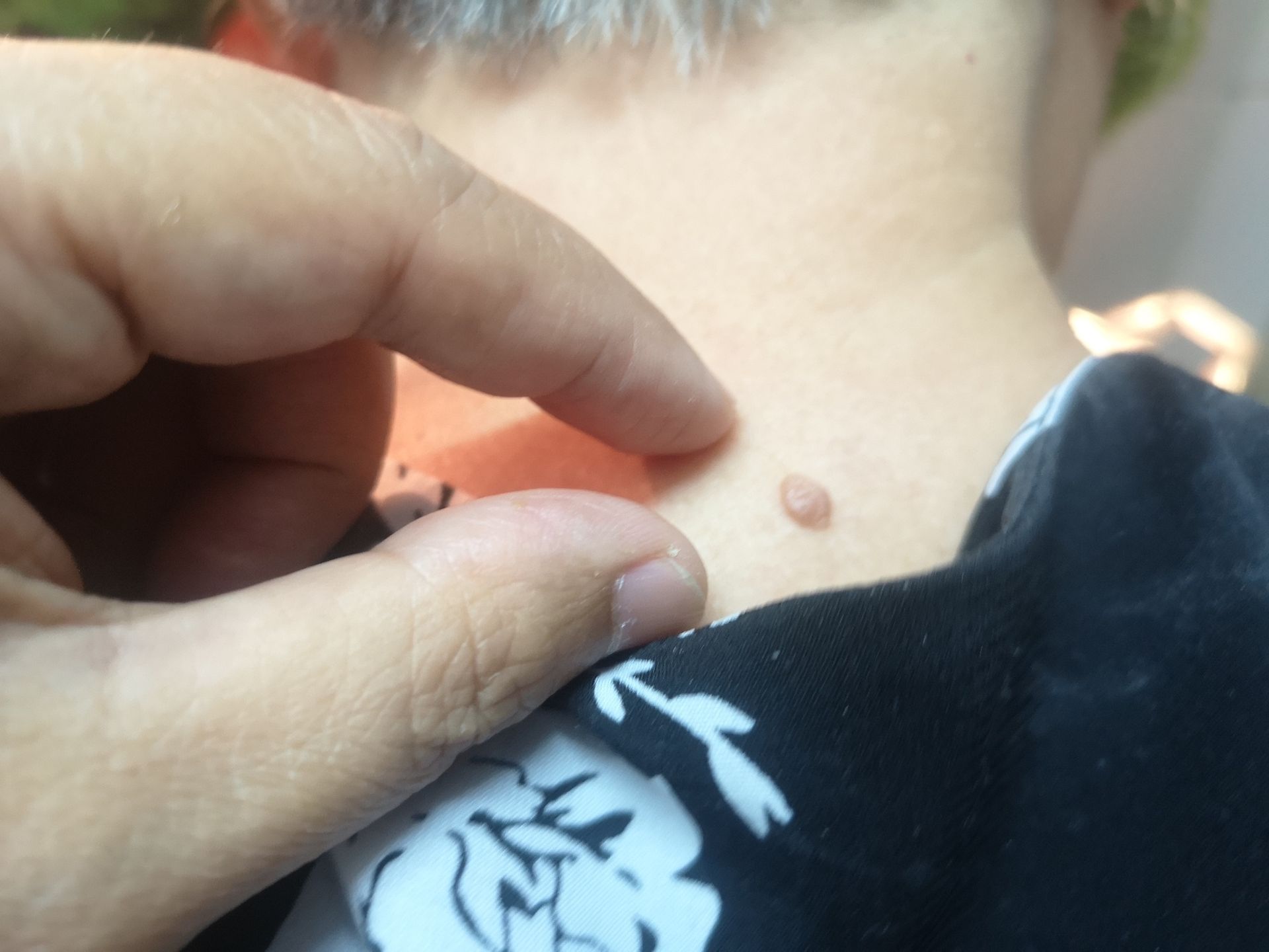 Thumb and index finger holding wart on nape of the neck
Thumb and index finger holding wart on nape of the neck
Penpak Ngamsathain