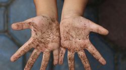 Objawy glisty ludzkiej - pierwsze symptomy, diagnostyka