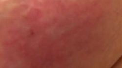 Rak zapalny piersi - groźny i dynamiczny nowotwór