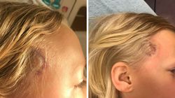 Kolejny nietypowy objaw boreliozy. To zdjęcie pomoże w szybkiej diagnozie