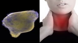 Objawy raka przełyku. Zobacz, czy znasz (WIDEO)