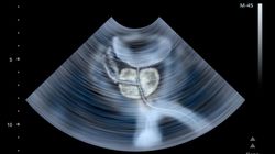 Badania prostaty - badanie per rectum, PSA, USG, biopsja, rezonans