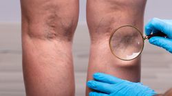 Powikłania po COVID-19. Koronawirus może powodować problemy naczyniowe. Coraz więcej pacjentów z niewydolnością żylną, zakrzepicą i zapaleniem żył