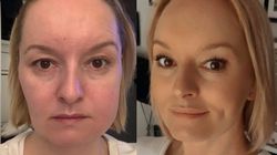 Komplikacje po wyrwaniu ósemki. Agnieszka pół roku walczyła z powikłaniami