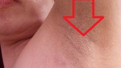 Odczyn poszczepienny przypominający nowotwór piersi. Czy jest się czego obawiać? Wyjaśnia prof. Szuster-Ciesielska