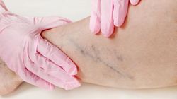 Objaw Homansa - na czym polega i co oznacza?