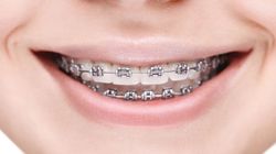 Gumki separacyjne - do czego służą i jak je założyć?