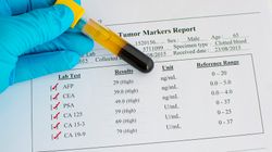 Markery nowotworowe - charakterystyka, przebieg badania, interpretacja wyników