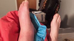 Spuchnięte nogi podczas upałów? Prof. Paluch: "Mamy destrukcję całego mikrokrążenia i całego układu żylnego"