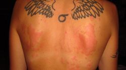 Mogą być czerwone, brązowe lub żółte. Sprawdź, co oznaczają plamy na skórze