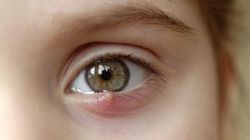 Jęczmień - rodzaje, przyczyny, objawy, domowe sposoby, leczenie