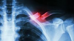 Złamanie obojczyka - postępowanie, leczenie, rekonwalescencja, powikłania