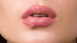 Opryszczka - klasyfikacja, objawy, rozpoznanie, leczenie, profilaktyka