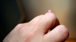 Brodawki - rodzaje, przyczyny, objawy, usuwanie brodawek