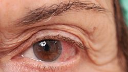 Oko - wady wzroku, higiena, dieta. Choroby oczu jako skutek cukrzycy, nadciśnienia czy alergii