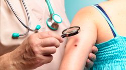 Choroba Bowena - przyczyny, objawy, rozpoznanie, leczenie