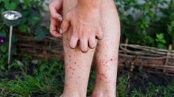 Krostki na skórze mogą zwiastować problemy z jelitami. Nie ignoruj