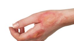 Oparzenia - jak powstają, stopnie oparzeń, zagrożenia, metody łagodzenia objawów