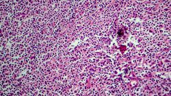 Chłoniak Hodgkina (ziarnica złośliwa) - charakterystyka, klasyfikacja, diagnostyka i metody leczenia