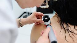 Znamię Suttona - przyczyny, wygląd i leczenie