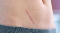 Usunięcie wyrostka robaczkowego (appendektomia) - przebieg laparoskopii, efekty uboczne zabiegu