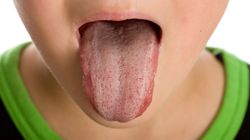 Żółty nalot na języku - przyczyny, choroby, leczenie