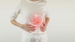 Przepuklina żołądka - przyczyny, objawy, leczenie