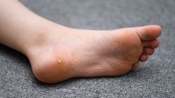 Kurzajka na stopie - skąd się bierze i jak ją usunąć?