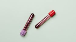 Wysokie monocyty - czym są monocyty, co oznacza podwyższony poziom monocytów, normy