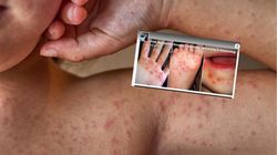 Na południu Polski rośnie liczba przypadków choroby dłoni, stóp i jamy ustnej. To nie bostonka