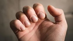 Wygląd palców może zdradzać groźną chorobę. Czym jest "strzelający palec"?