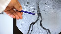 Choroby aorty - wrodzone i nabyte. Czy są groźne?