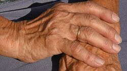 Ciężki przebieg COVID a wygląd palców. Zaskakujące badanie 