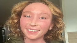 Postanowiła odstawić krem ze sterydami. "Po pięciu miesiącach zaczęło się piekło" 