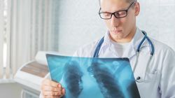 Mikroskopowe zapalenie naczyń - przyczyny, objawy i leczenie