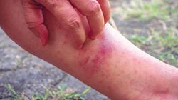 Groźne ukąszenia meszek. "Pojawiają się wręcz rany i odczyny rumieniowe"