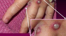 Małpia ospa - co to jest, objawy, leczenie