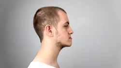 Progenia (wysunięta żuchwa) - charakterystyka, przyczyny, leczenie