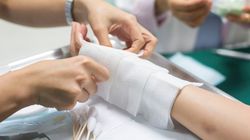 Choroba oparzeniowa - fazy, objawy, leczenie i rokowania