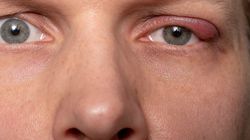 Gruczoł Meiboma - budowa, rola, dysfunkcja i leczenie